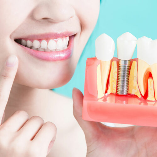 Everything to know about dental implant procedure